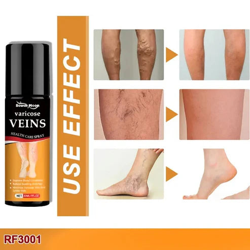 BEE VENOM VARICOSE VEINS RELIEF SPRAY (BUY 1 GET 1 FREE)(PACK OF 2)